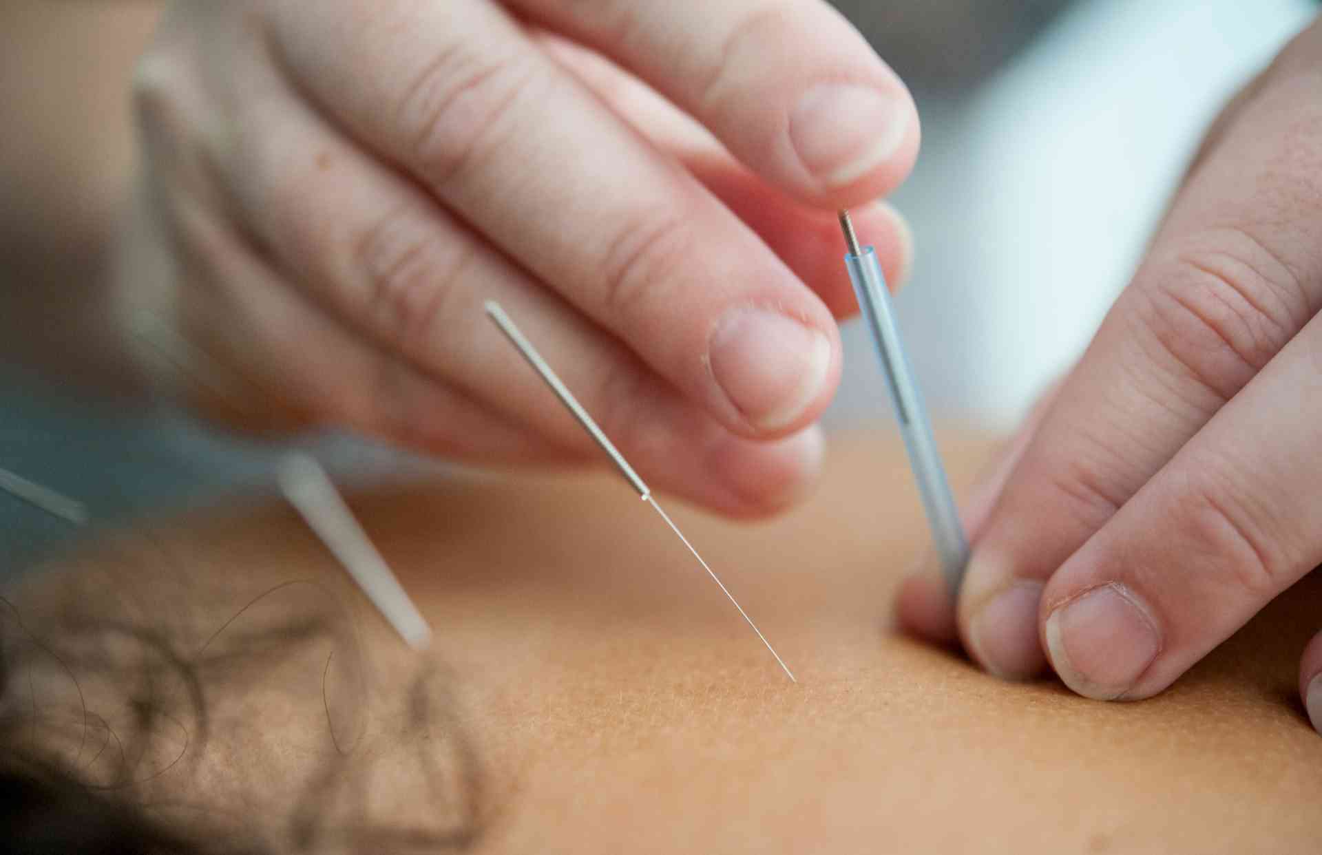 Acupuncture treatment — practitioner placing needles with care